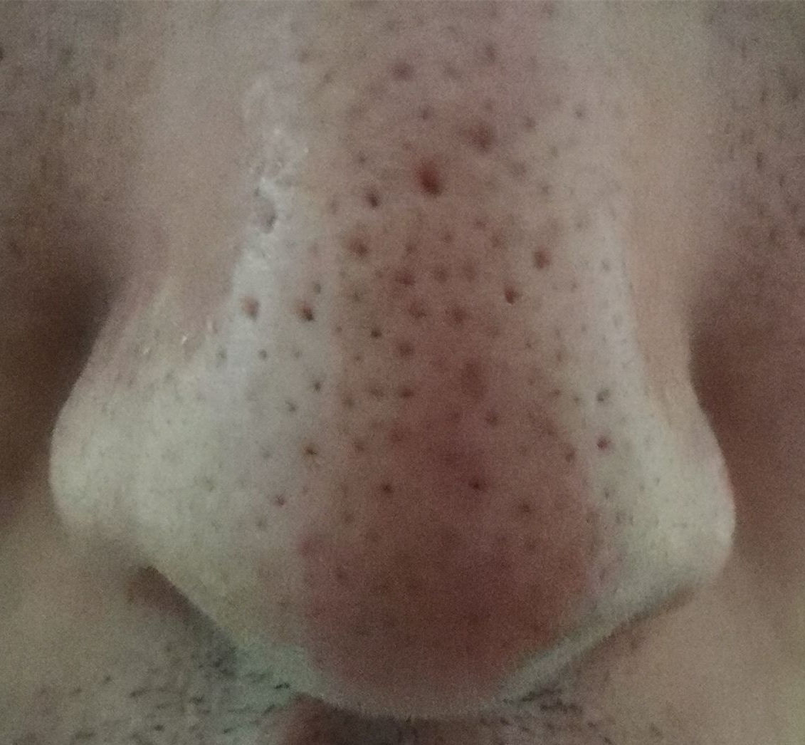 真黑头假黑头傻傻分不清楚，怎么去黑头？