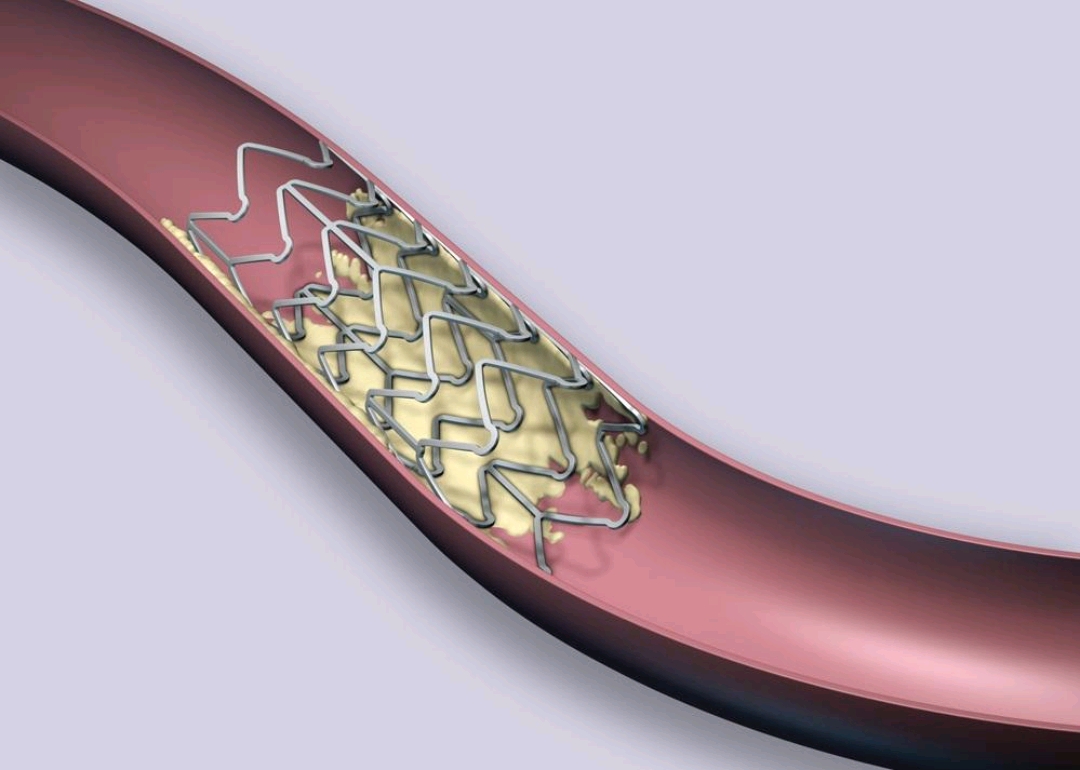 氯吡格雷、替格瑞洛，支架术后选择哪个疗效会更好？医生讲清楚