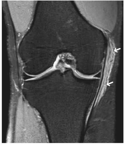 内侧副韧带损伤自测图,mcl内侧副韧带