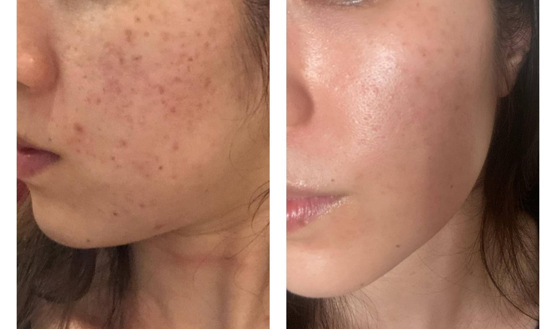 用了护肤品皮肤刺痛是缺水吗,护肤刺痛缺水怎么回事