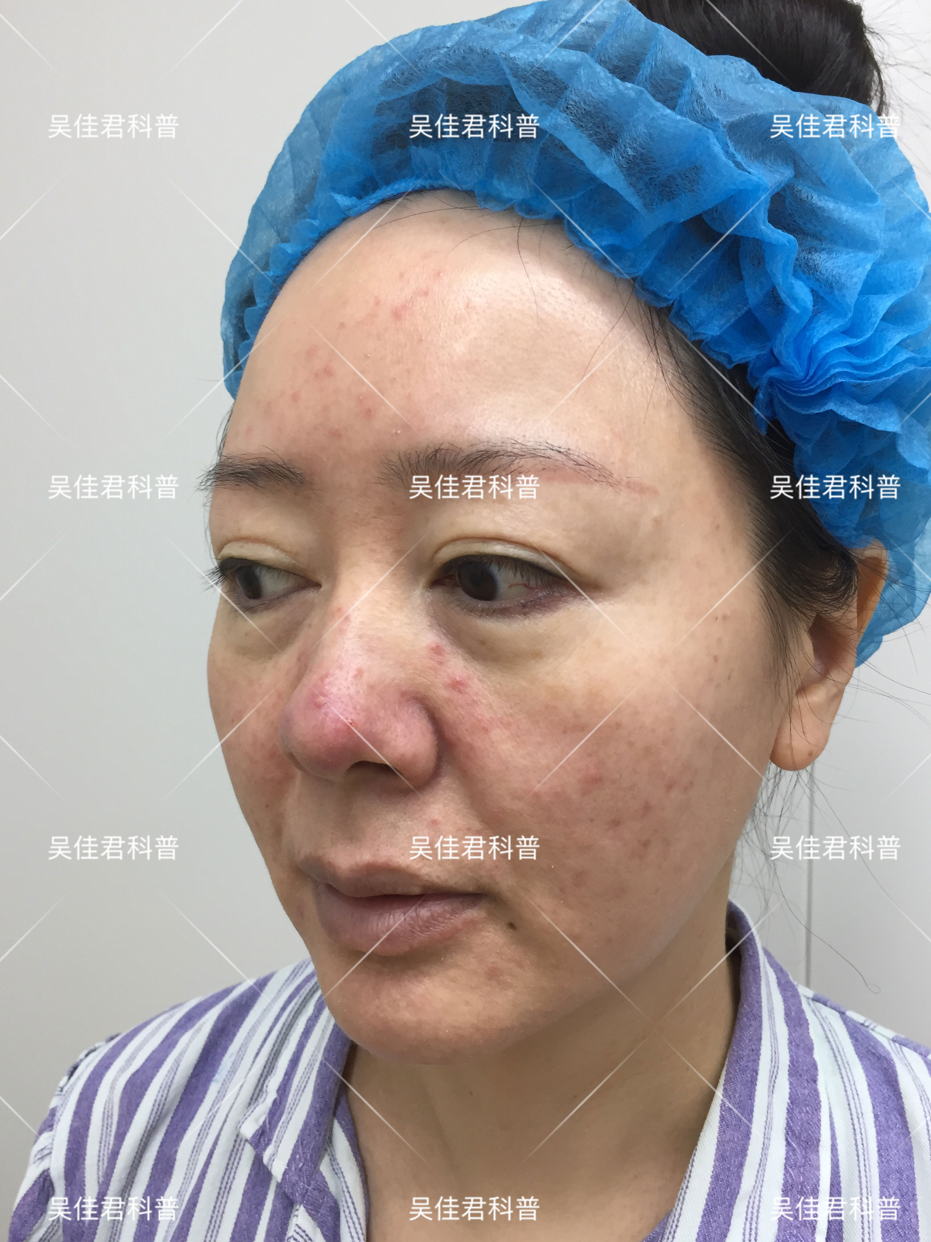 全脸皱纹拉皮手术对比,面部大拉皮恢复的真实感受