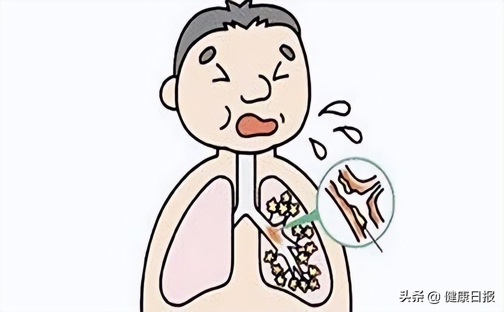 支气管发炎怎么好得快,支气管发炎有什么食疗的方法