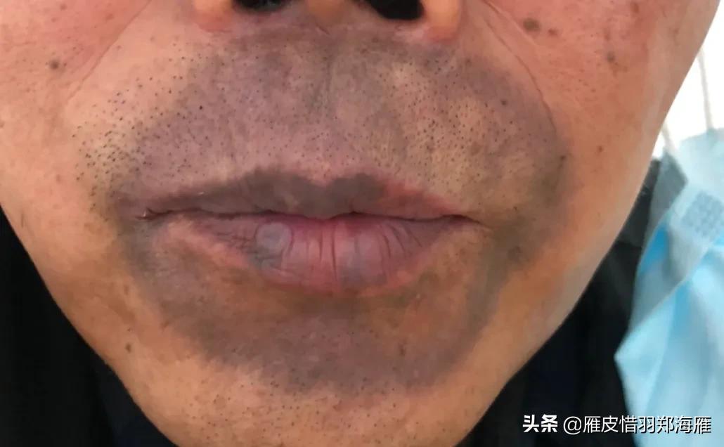 嘴周长红疹子是什么原因,无缘无故过敏起红点