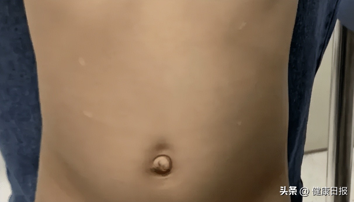 宝宝脖子有白色的圆点,宝宝皮肤上白色圆圈