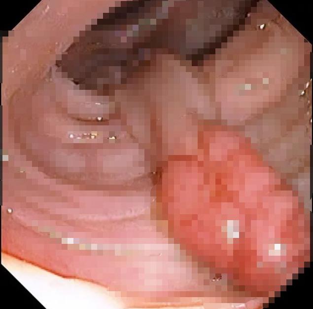 不容忽视的息肉很容易变成癌,肠息肉不可小觑