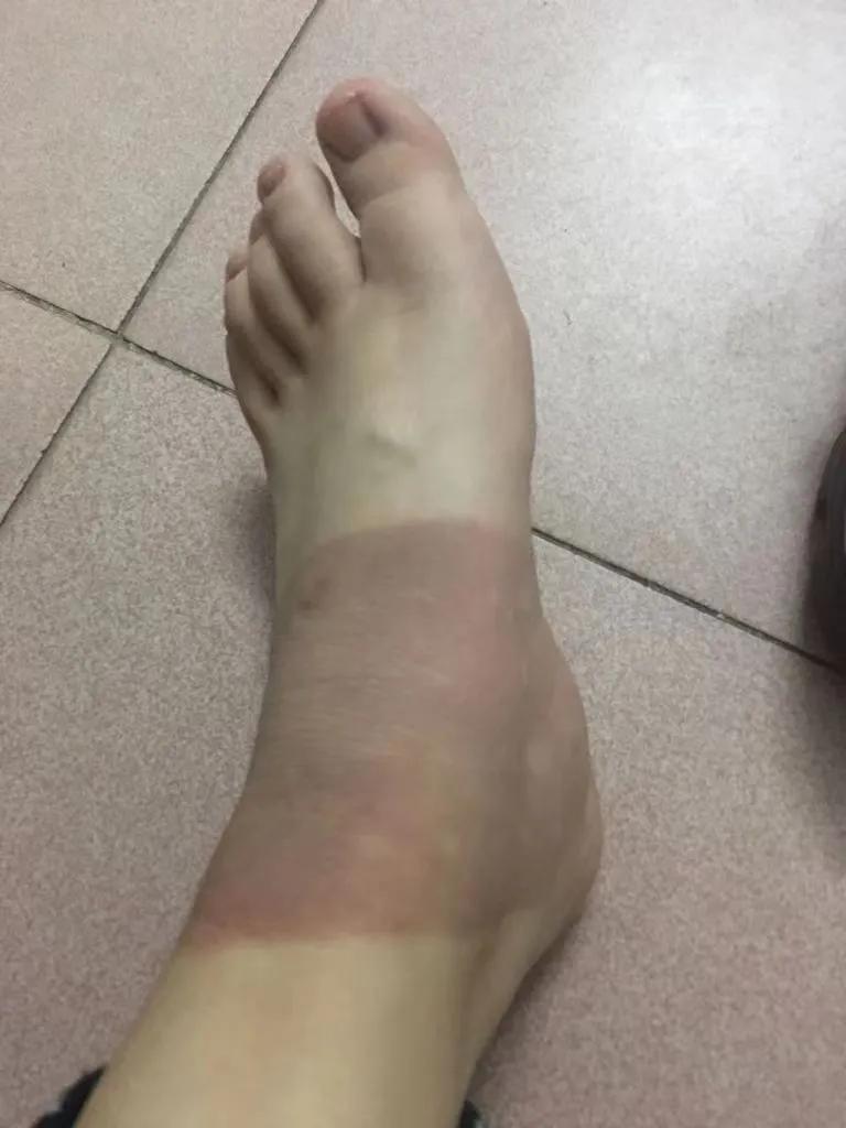 美女教你脚踝扭伤的紧急处理方法,脚踝扭伤肿了怎么处理能快速消肿