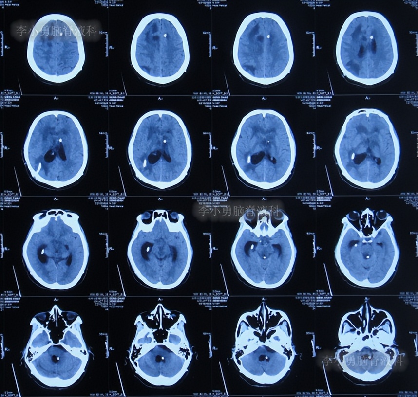 脑积水三脑室造瘘多久能恢复,脑囊虫手术后脑积水