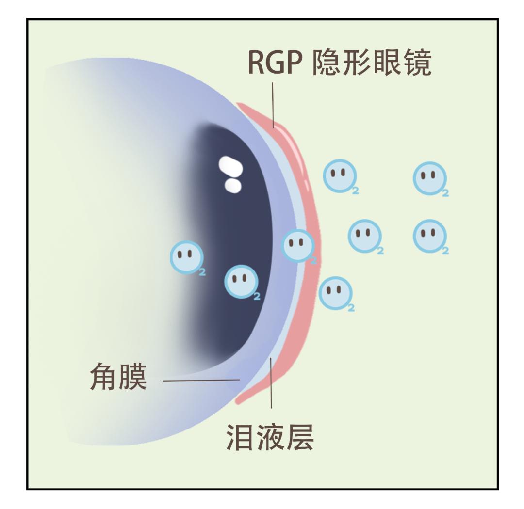 38%含水量的隐形眼镜戴的眼干,眼干隐形眼镜含水量的选择