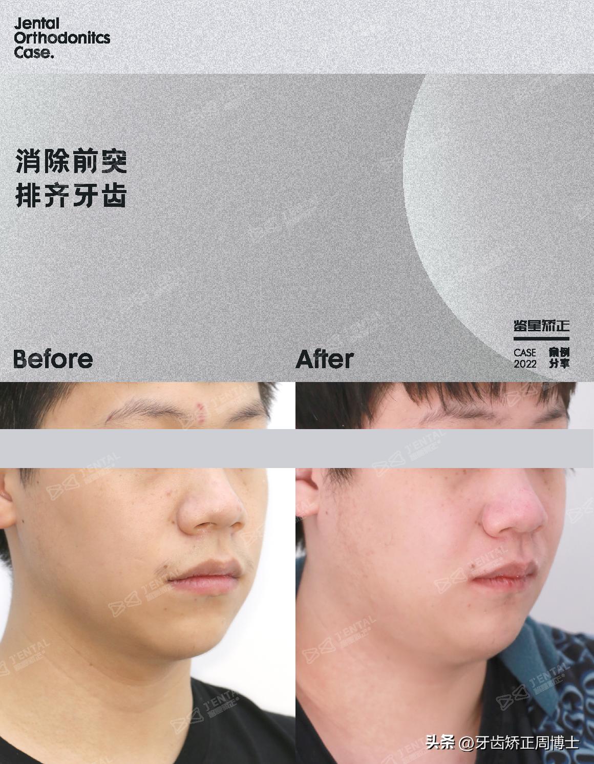 小孩牙齿为什么迟迟不长,孩子牙齿刚长出来不齐怎么办