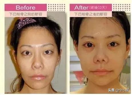 整容达人200次整容失败整成僵尸,整容成功逆袭案例削骨
