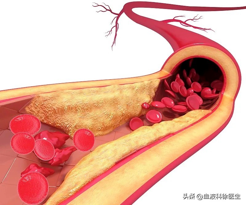 进口他汀太贵能换成便宜的吗,进口的他汀有哪几种