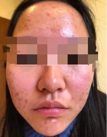 痘痘肌的十大内调方法,痘痘肌要怎么内调