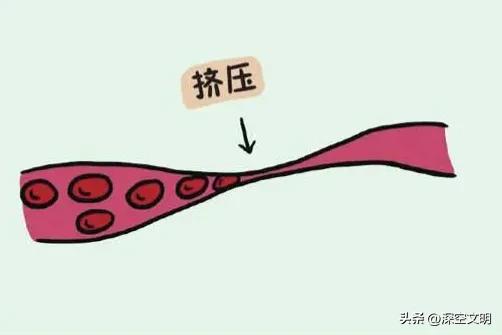 蹲厕所脚麻小妙招,蹲厕所脚麻脚筋痛是什么病的前兆