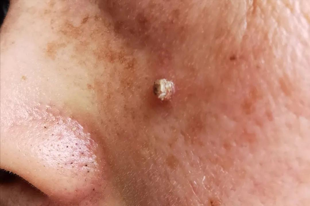 hpv和疣是一种病吗,hpv病毒疣是什么样的