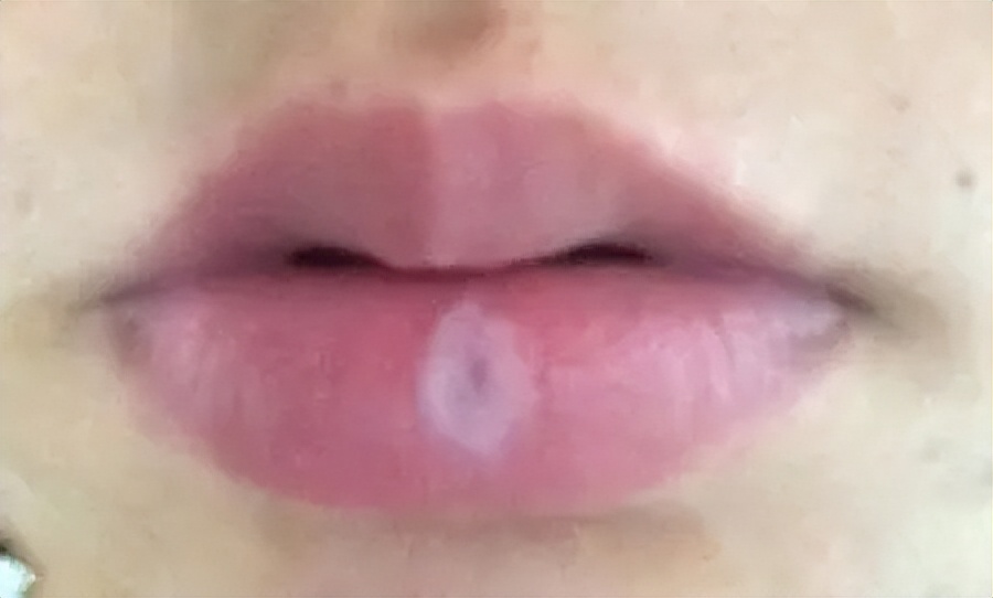 白癜风发现时从什么部位开始发现,各个部位白癜风哪里最好治疗