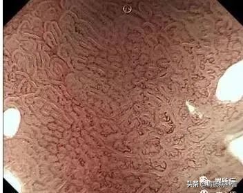 胃低分化含印戒细胞癌早期存活率,得印戒细胞癌的女孩