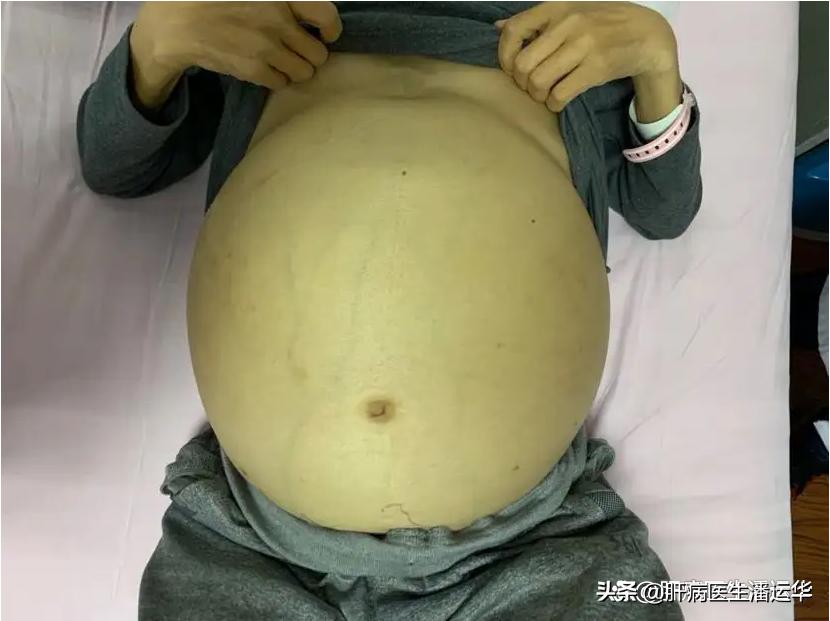 女子被顽固性腹水折磨半年，中医辩证论治后实现逆转