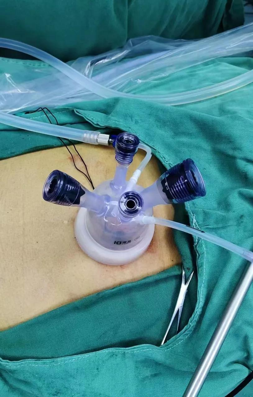 微创跟单孔腹腔镜的区别,微创腹腔镜单孔取胆结石