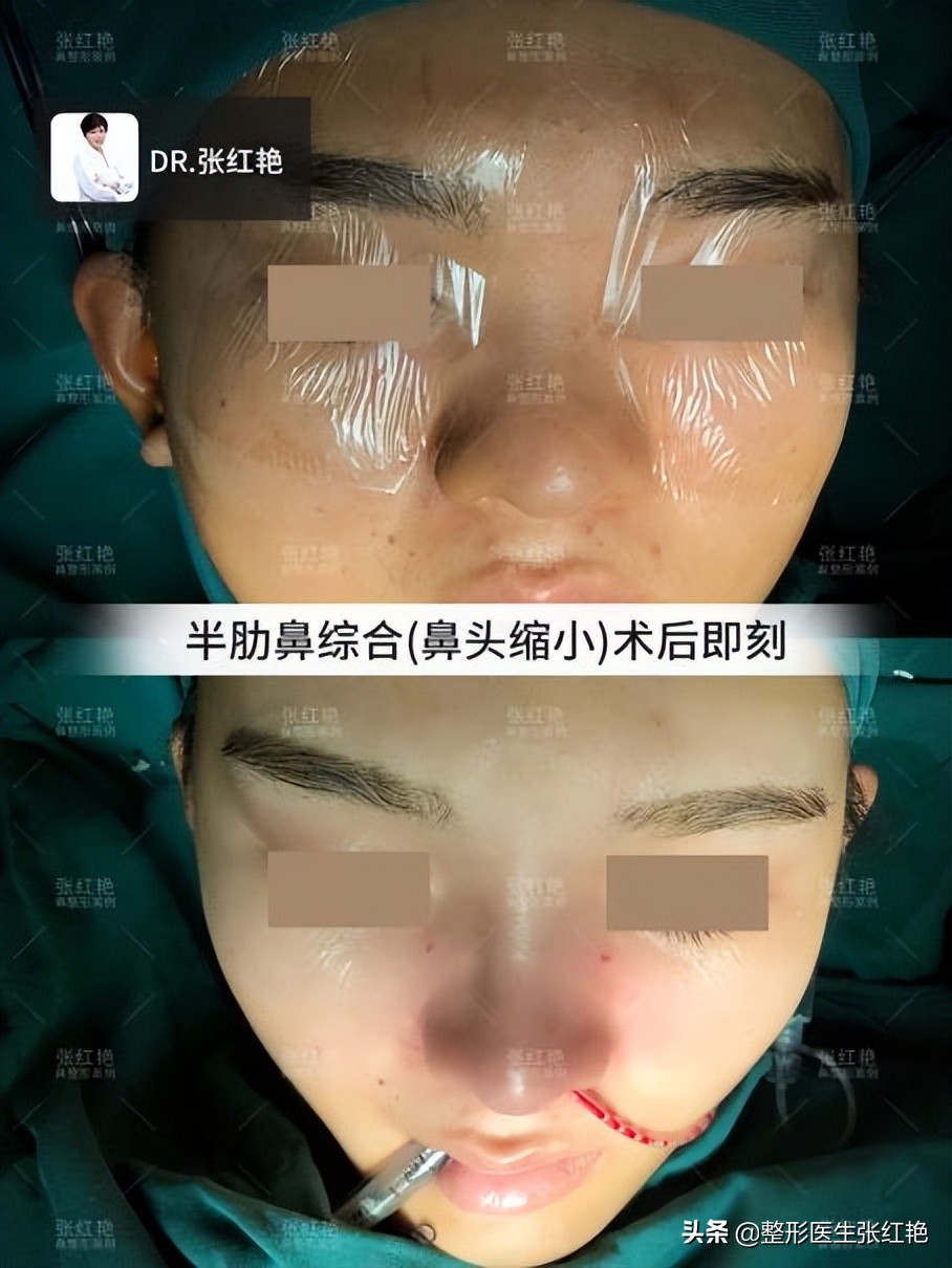 鼻部皮肤厚怎么办,鼻头软组织肥厚应该用什么材料