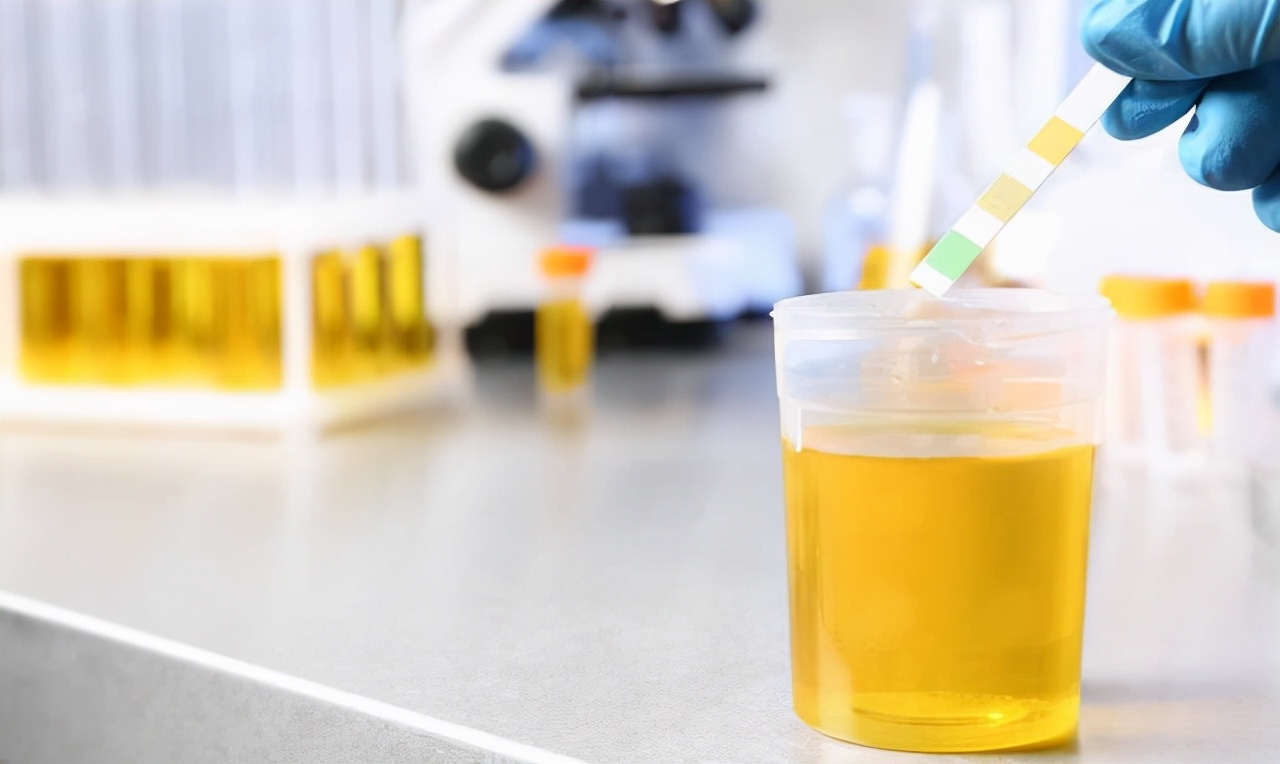 检查出尿蛋白“+”号，是得了肾病吗？常吃2物，或帮你降低尿蛋白