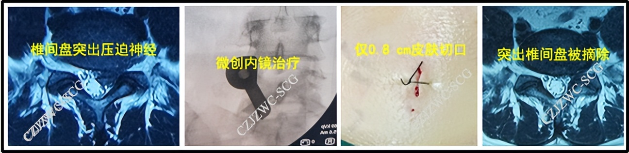 腰椎退行变性是什么原因,腰椎退变治愈的可能性
