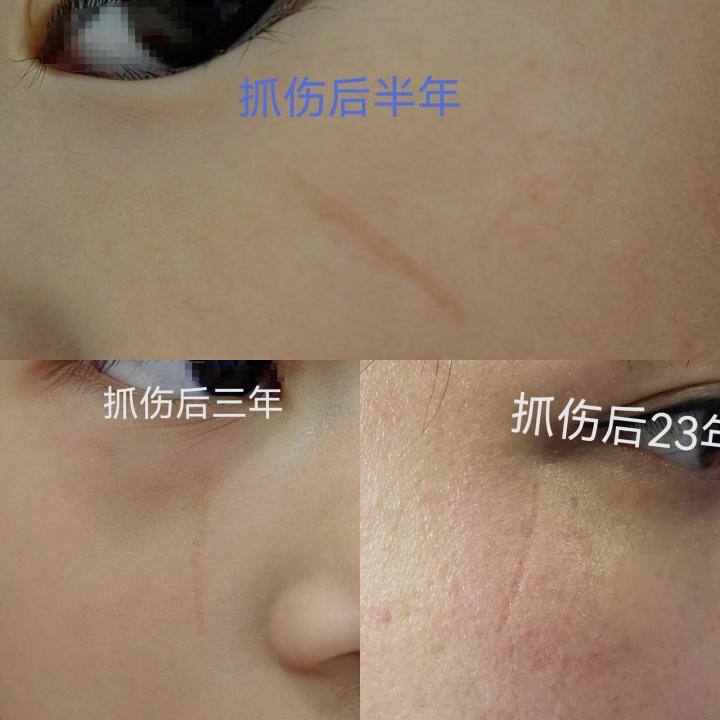 点阵激光后的伤口要几天愈合,点阵激光对去除疤痕效果明显吗