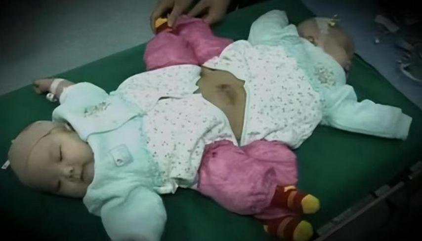 连体婴姐妹18年成功分离,连体婴姐妹成功分离后续