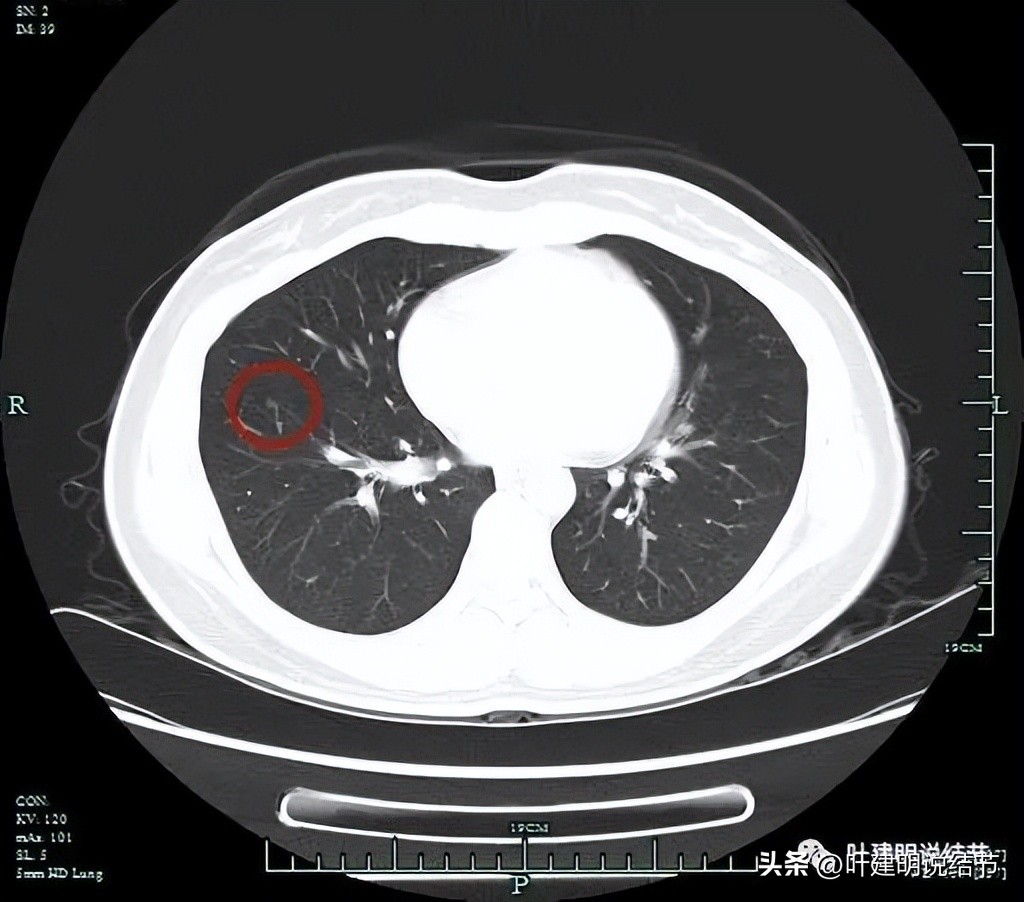 磨玻璃结节伴有增生是癌症吗,磨玻璃结节会是别的癌转移的吗