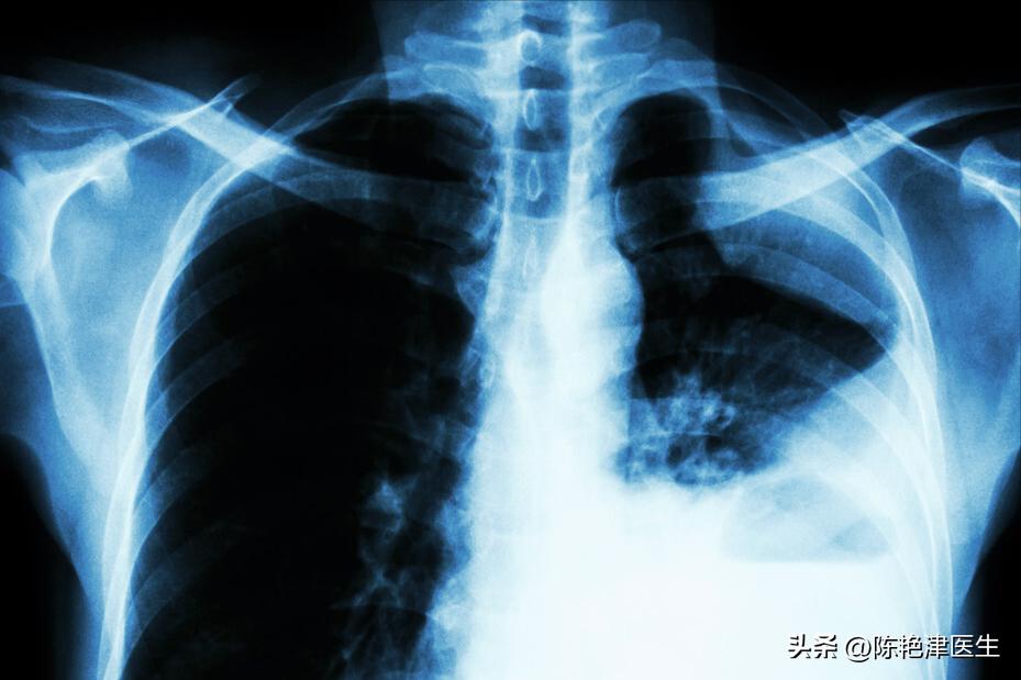 赵忠祥鳞状细胞癌早期症状,赵忠祥鳞状细胞癌有什么症状