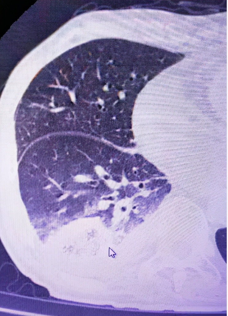 甲状腺结节消融术病例分析,肺部结节冷冻消融