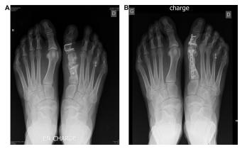 拇外翻术后——拇内翻治疗