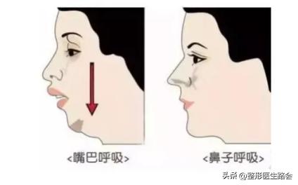 最让人显老的法令纹应该如何解决,法令纹和嘴角纹哪个更显老