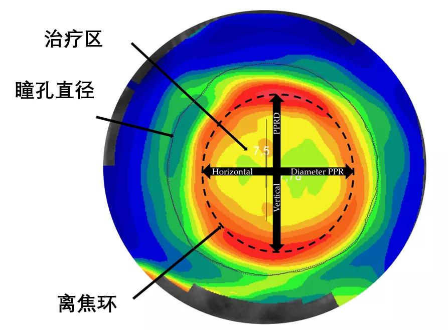 ok镜多少的偏位对近视防控好,佩戴ok镜两眼矫正视力不一致
