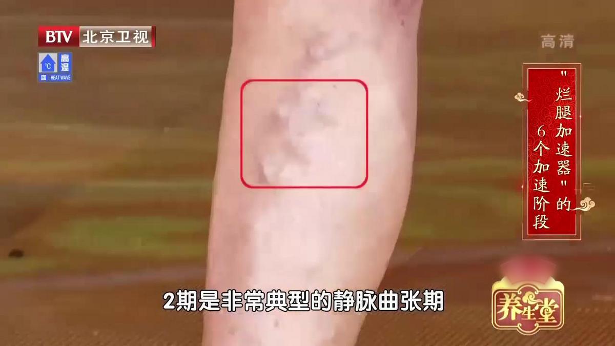 腿酸胀难受怎么缓解静脉曲张,单腿小腿酸胀发麻是静脉曲张吗