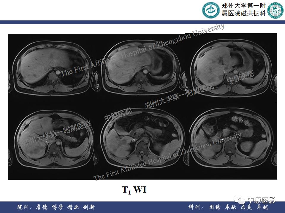 肝脏血管瘤样本,正确认识肝脏血管瘤文章