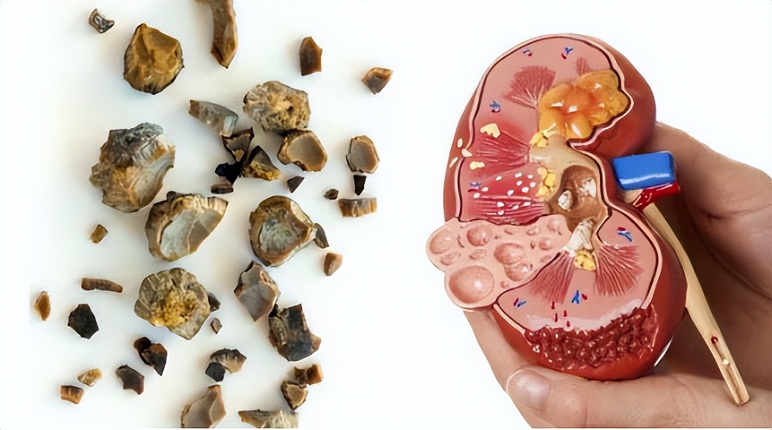 肾结石能吃蛋一类的食物吗,肾结石治疗期间可以吃鸡蛋吗