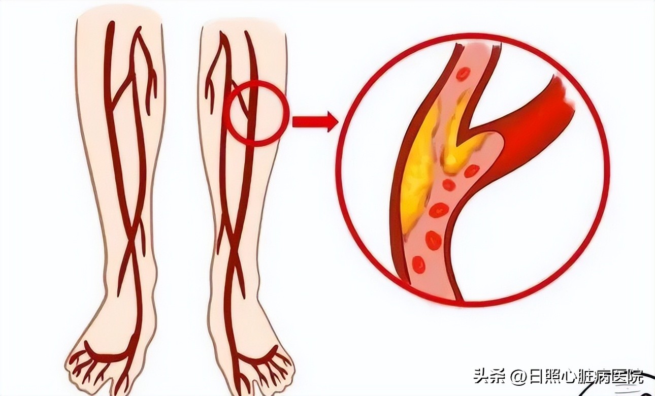 腿脚发凉别大意可能是大病,腿脚冰凉是不好的征兆吗