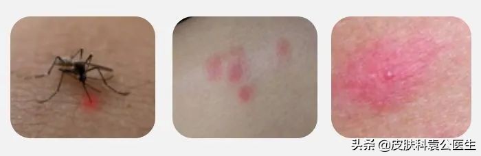 儿童被蚊虫叮咬导致过敏性皮炎,各类虫子叮咬后皮肤都有哪些症状