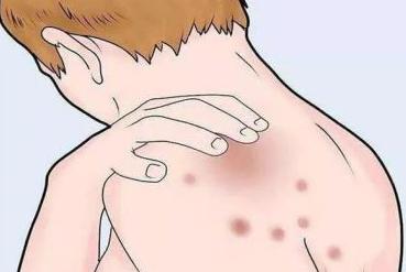 皮肤病玫瑰糠疹怎么得的,玫瑰糠疹和银屑病区别