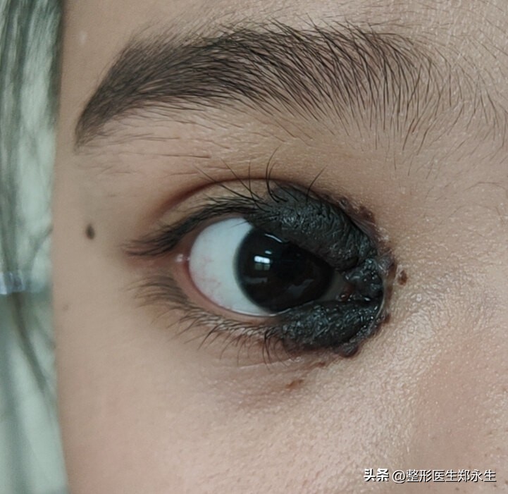 长在眼睛上的肿瘤,长在眼睛周围的痣
