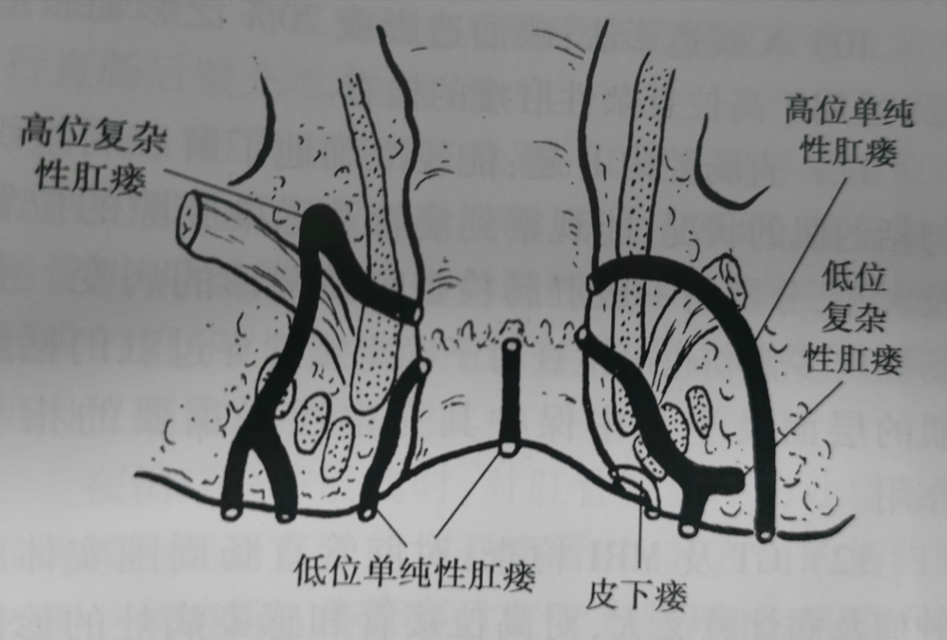 为什么有些人肛瘘一个星期就好了,为什么有的肛瘘术后不需要换药