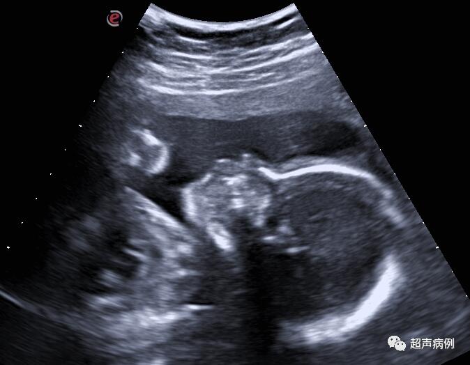 超声上第一次看到孩子的感受,超声检查实录
