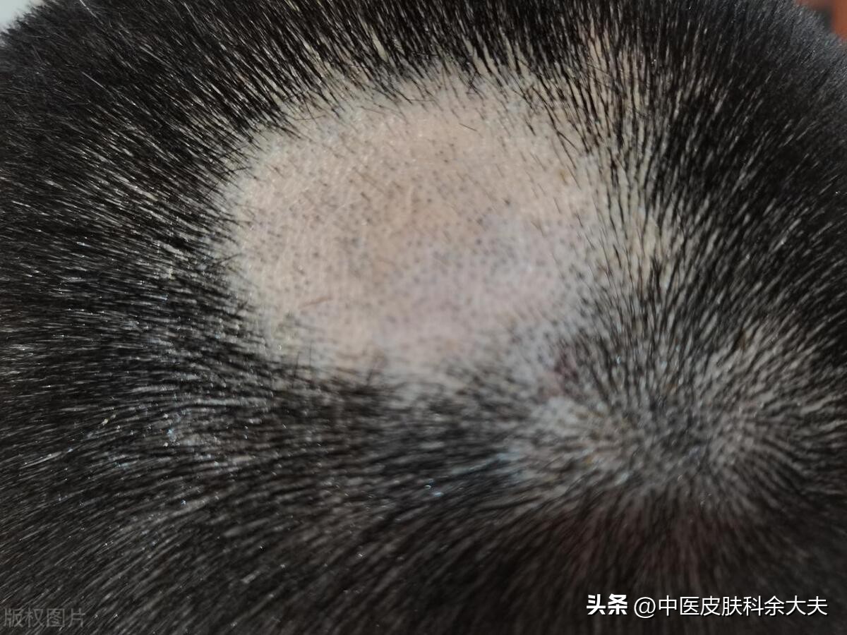 脱发原来这么容易治好,女的脂溢性脱发最简单自愈方法