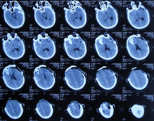 脑外伤后硬膜下积液颅骨修补,颅骨修复手术失败导致脑积水