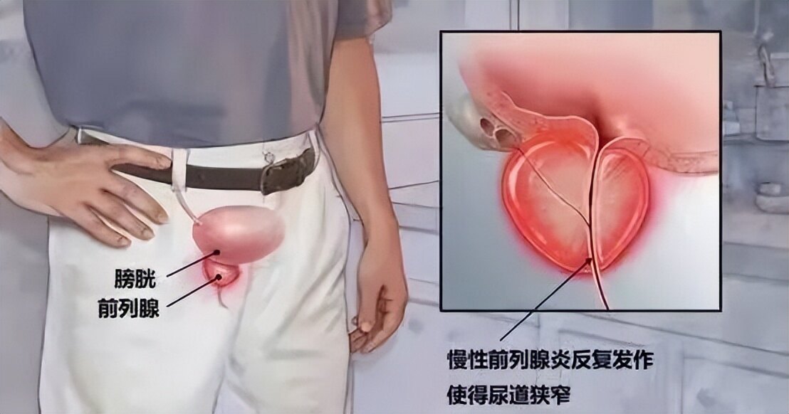 慢性前列腺炎和前列腺炎哪个难治,细菌性和非细菌性前列腺炎哪个难治