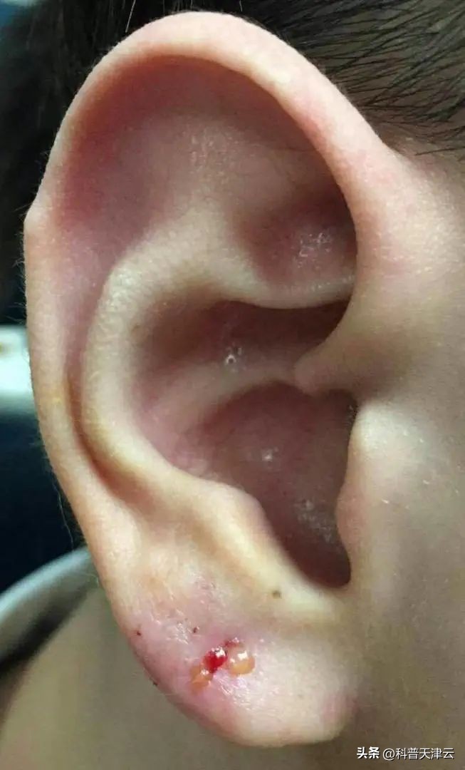 冬季打耳洞有什么注意事项,耳洞小打耳洞有什么忌讳