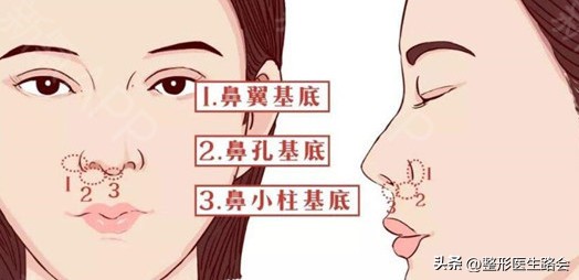 鼻基底凹陷戴牙套会变丑吗,垫了鼻基底感觉人变丑了