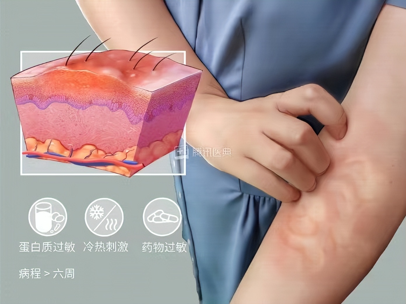 荨麻疹常识,荨麻疹知识