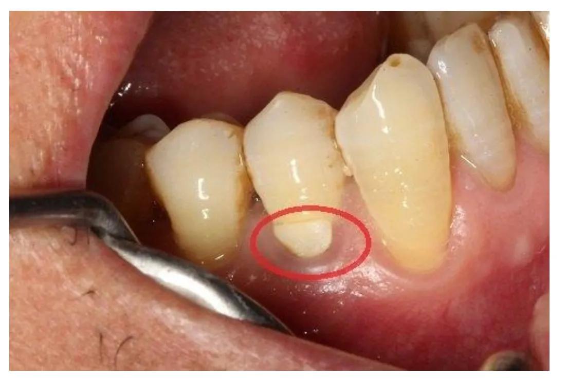 牙齿历险记（第12集）补牙材料