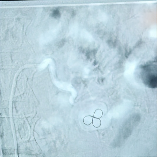 门医技术|区医院肿瘤与介入科成功解除藏在患者体中的“定时*弹炸**”——动脉瘤